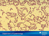 Clostridium Difficile: New Problems with an Old Disease