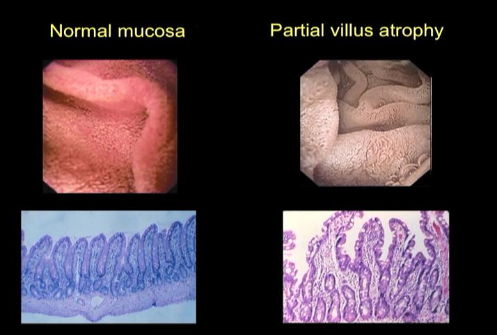 Gastrointestinal Disease in HIV Infection