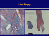 HBV & HIV: A Tale of Two Viruses and Many Drugs!