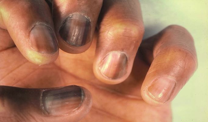 Primary-Care Diagnosis and Treatment of Common Dermatological Problems in HIV Medicine