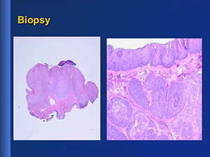 What's New in Prevention and Early Diagnosis of Anal Cancer in HIV Medicine