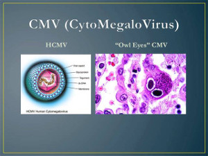 AIDS-defining CMV Retinitis & Colitis
