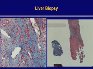 HBV & HIV: A Tale of Two Viruses and Many Drugs!