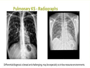 What's New in Kaposi Sarcoma?